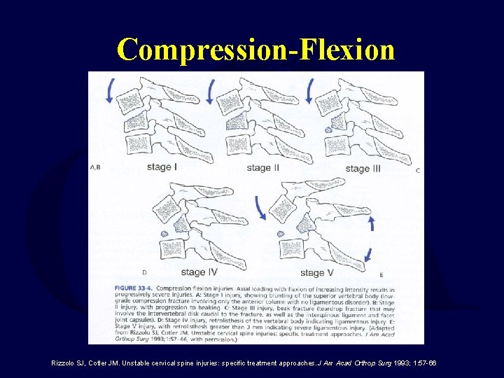 Compression-Flexion Rizzolo SJ, Cotler JM. Unstable cervical spine injuries: specific treatment approaches. J Am
