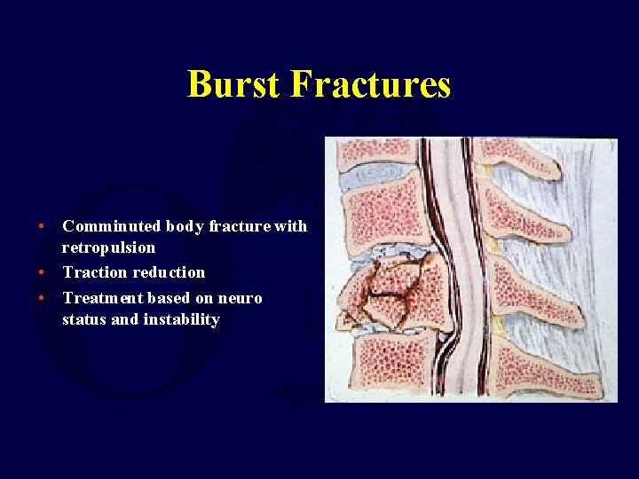 Burst Fractures • Comminuted body fracture with retropulsion • Traction reduction • Treatment based