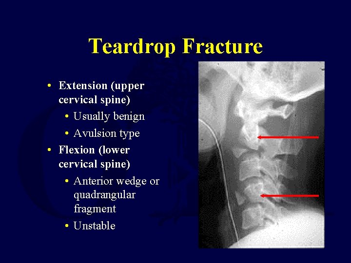 Teardrop Fracture • Extension (upper cervical spine) • Usually benign • Avulsion type •