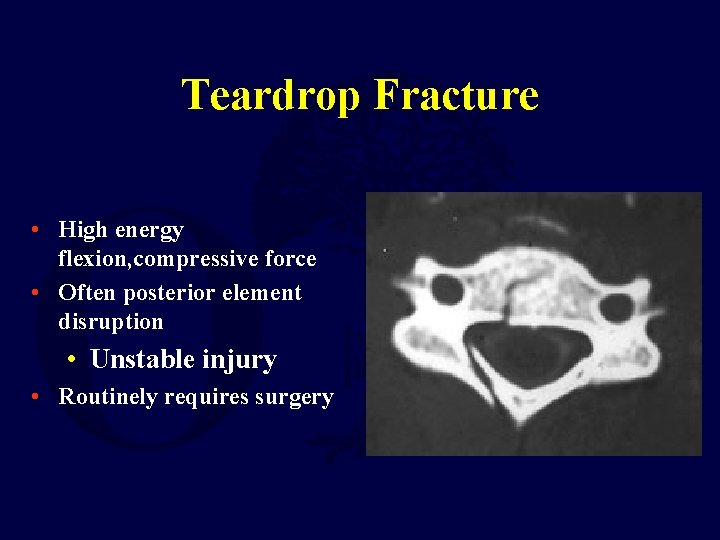 Teardrop Fracture • High energy flexion, compressive force • Often posterior element disruption •