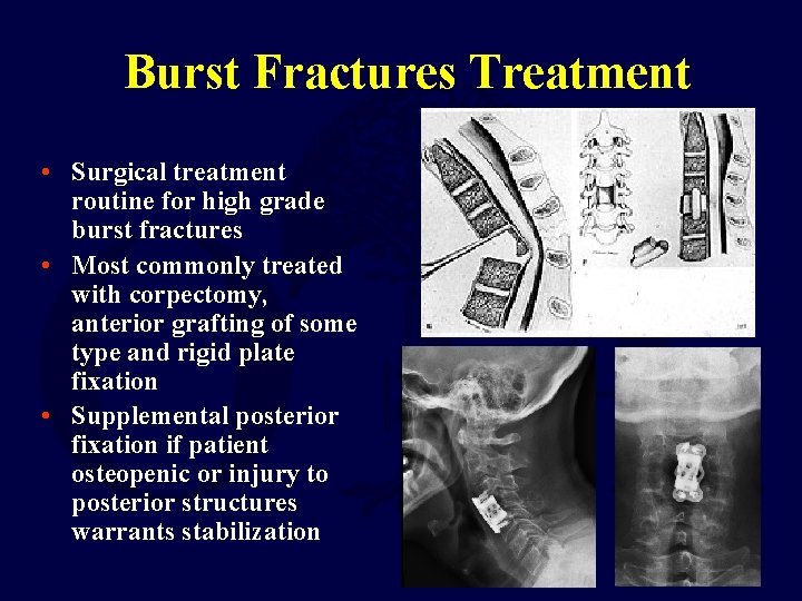 Burst Fractures Treatment • Surgical treatment routine for high grade burst fractures • Most