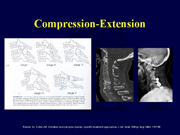 Compression-Extension Rizzolo SJ, Cotler JM. Unstable cervical spine injuries: specific treatment approaches. J Am