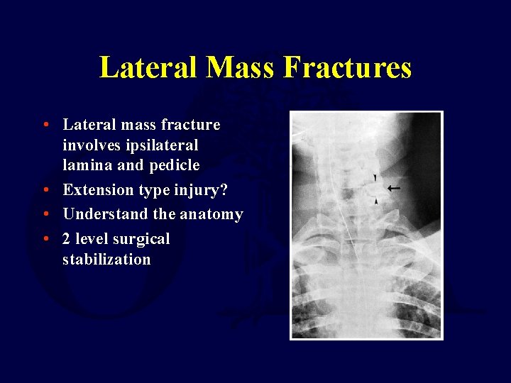 Lateral Mass Fractures • Lateral mass fracture involves ipsilateral lamina and pedicle • Extension