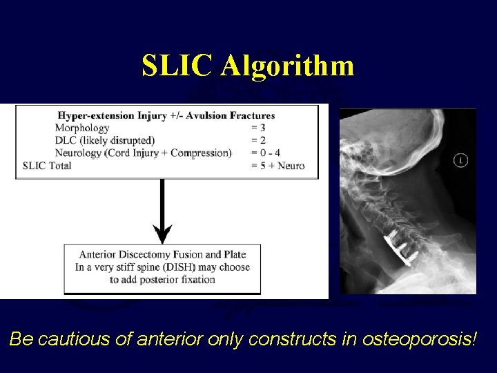 SLIC Algorithm Be cautious of anterior only constructs in osteoporosis! 