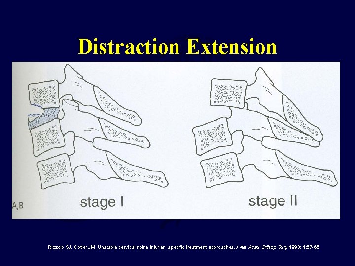 Distraction Extension Rizzolo SJ, Cotler JM. Unstable cervical spine injuries: specific treatment approaches. J