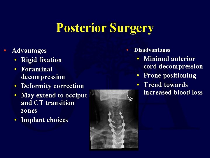 Posterior Surgery • Advantages • Rigid fixation • Foraminal decompression • Deformity correction •