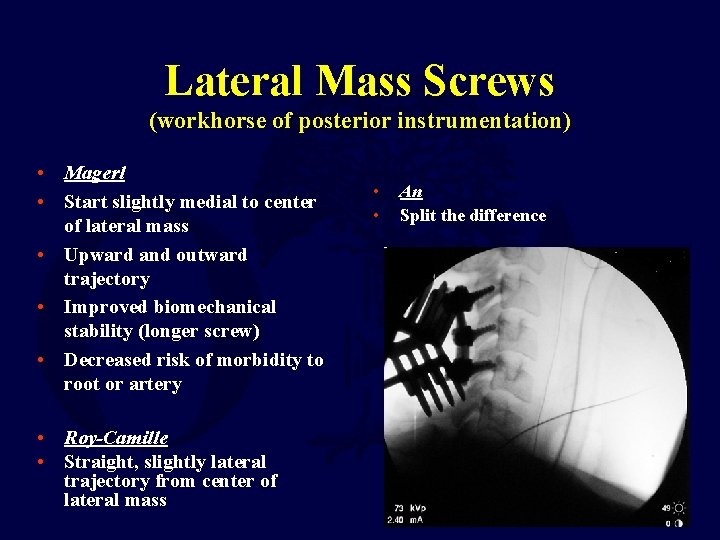Lateral Mass Screws (workhorse of posterior instrumentation) • Magerl • Start slightly medial to