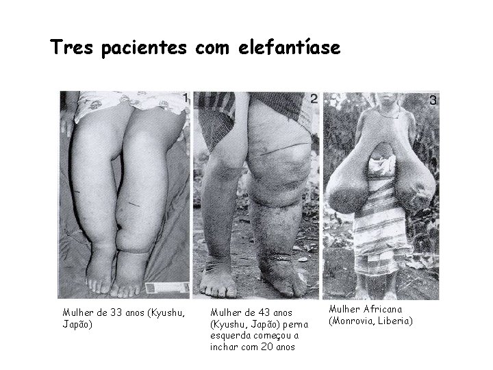 Tres pacientes com elefantíase Mulher de 33 anos (Kyushu, Japão) Mulher de 43 anos