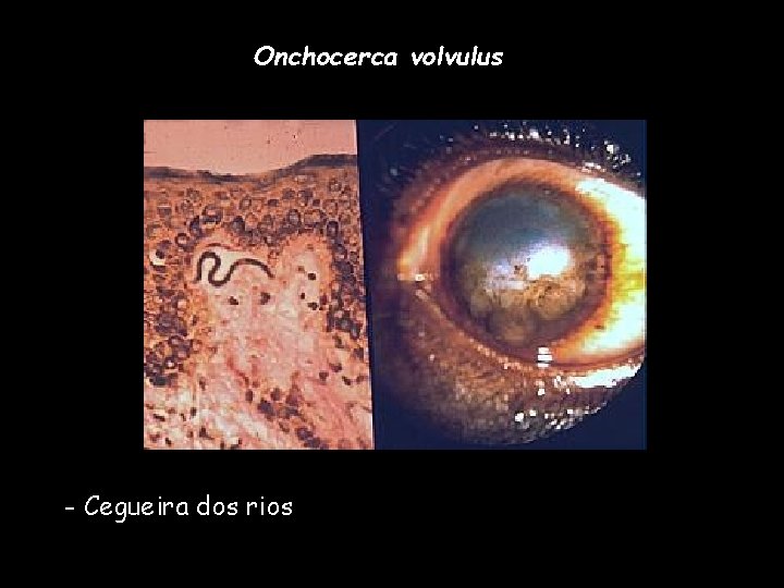 Onchocerca volvulus - Cegueira dos rios 