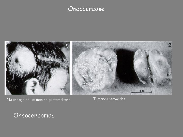 Oncocercose Na cabeça de um menino guatemalteco Oncocercomas Tumores removidos 