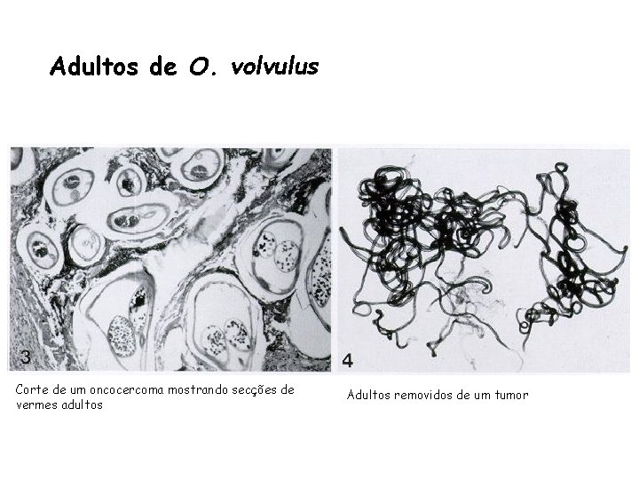 Adultos de O. volvulus Corte de um oncocercoma mostrando secções de vermes adultos Adultos