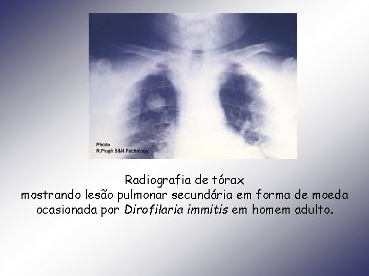Radiografia de tórax mostrando lesão pulmonar secundária em forma de moeda ocasionada por Dirofilaria