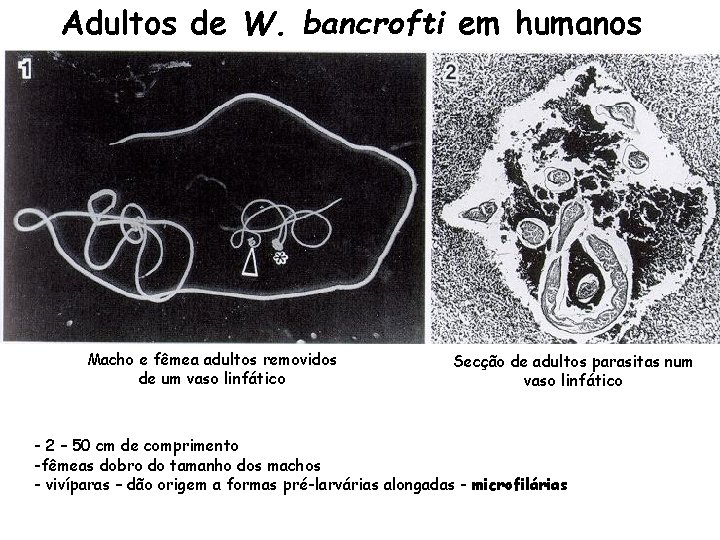 Adultos de W. bancrofti em humanos Macho e fêmea adultos removidos de um vaso