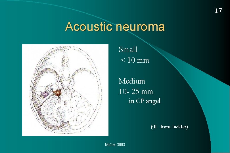 Acoustic Neuroma Vestibular Schwannoma Diagnosis and treatment Per