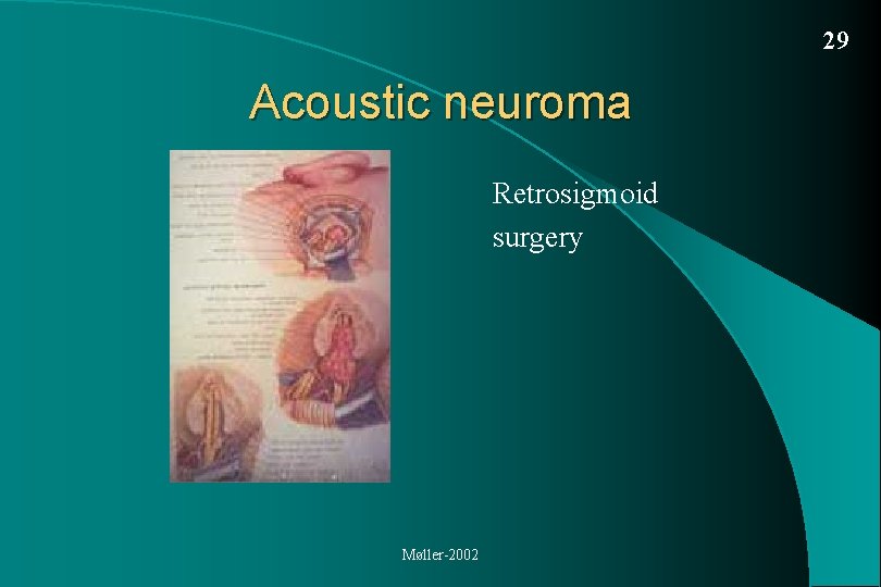 29 Acoustic neuroma Retrosigmoid surgery Møller-2002 