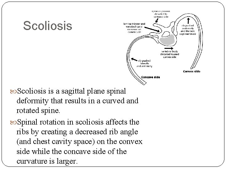 Scoliosis is a sagittal plane spinal deformity that results in a curved and rotated