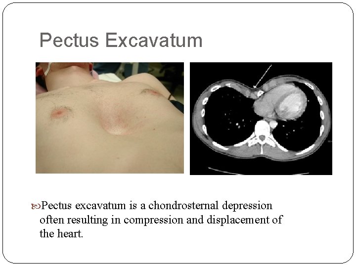 Pectus Excavatum Pectus excavatum is a chondrosternal depression often resulting in compression and displacement