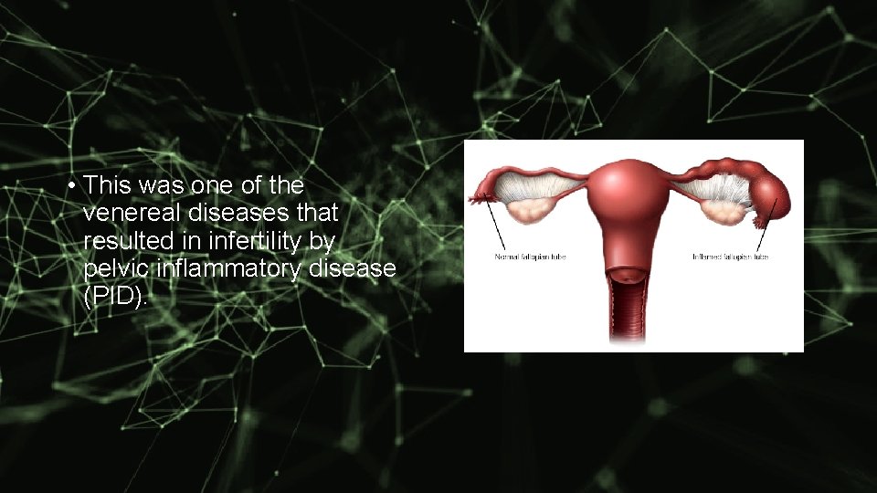  • This was one of the venereal diseases that resulted in infertility by