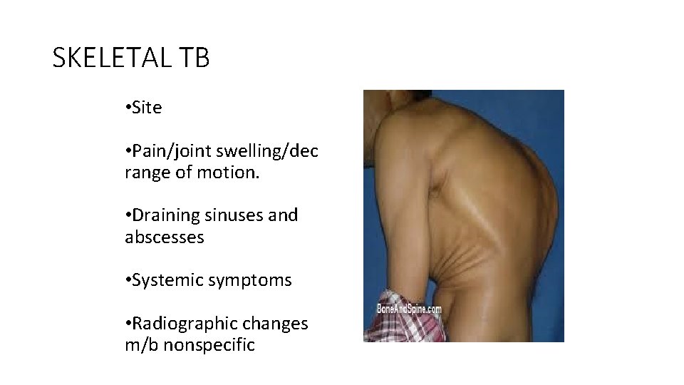 SKELETAL TB • Site • Pain/joint swelling/dec range of motion. • Draining sinuses and