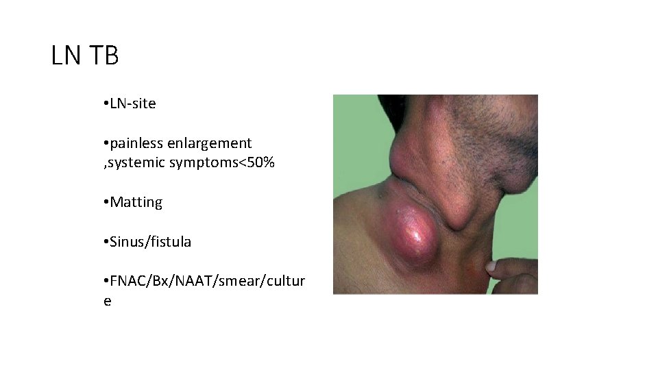 LN TB • LN-site • painless enlargement , systemic symptoms<50% • Matting • Sinus/fistula
