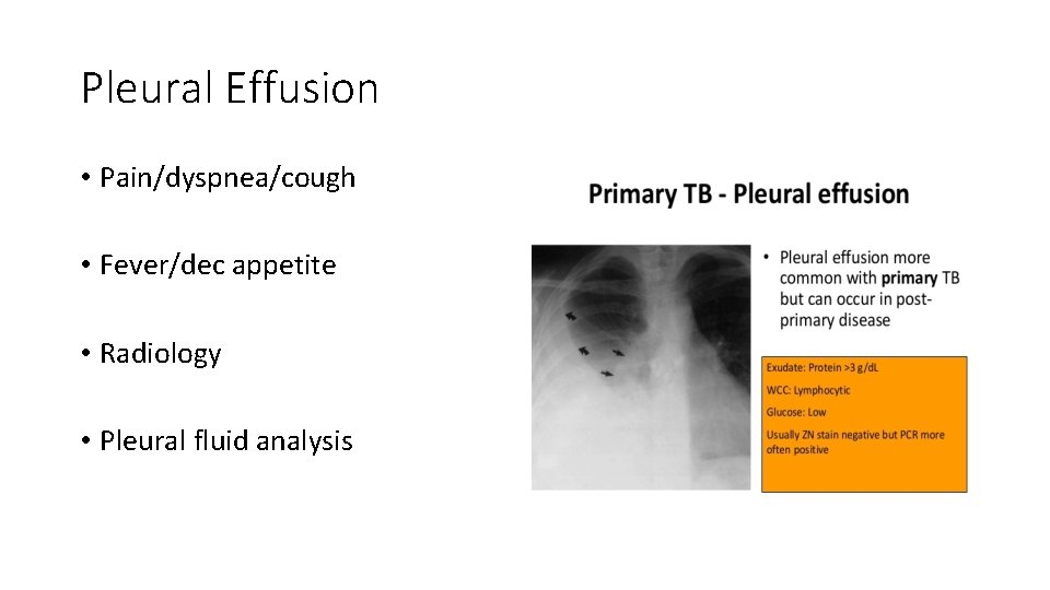 Pleural Effusion • Pain/dyspnea/cough • Fever/dec appetite • Radiology • Pleural fluid analysis 
