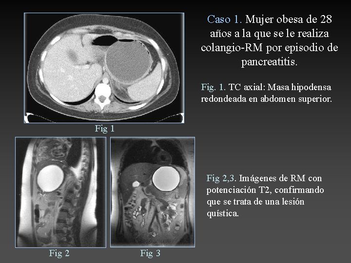 Caso 1. Mujer obesa de 28 años a la que se le realiza colangio-RM