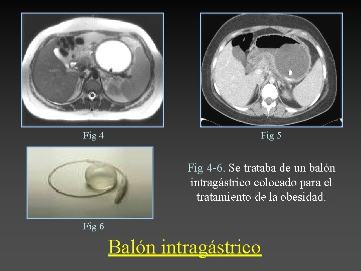Fig 4 Fig 5 Fig 4 -6. Se trataba de un balón intragástrico colocado