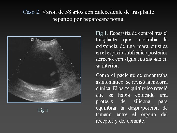 Caso 2. Varón de 58 años con antecedente de trasplante hepático por hepatocarcinoma. Fig