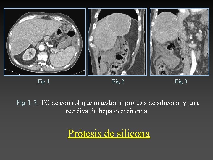 Fig 1 Fig 2 Fig 3 Fig 1 -3. TC de control que muestra
