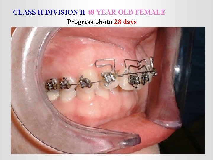 CLASS II DIVISION II 48 YEAR OLD FEMALE Progress photo 28 days 
