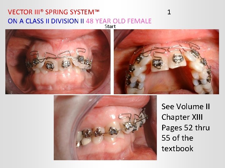 VECTOR III® SPRING SYSTEM™ ON A CLASS II DIVISION II 48 YEAR OLD FEMALE