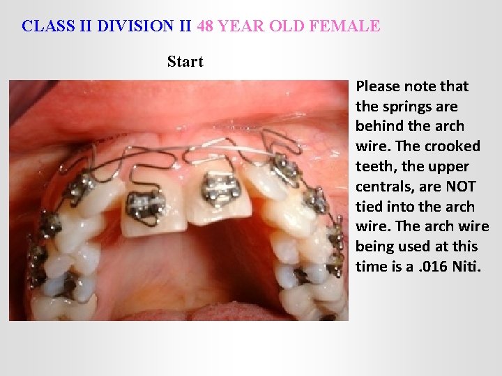 CLASS II DIVISION II 48 YEAR OLD FEMALE Start Please note that the springs