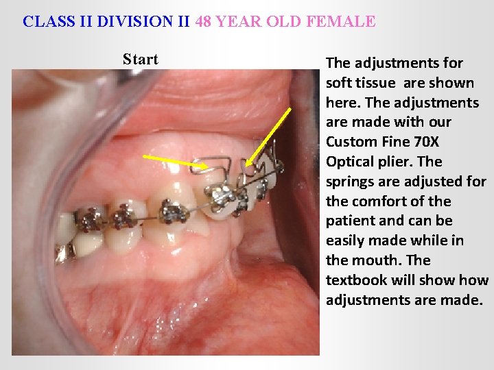 CLASS II DIVISION II 48 YEAR OLD FEMALE Start The adjustments for soft tissue