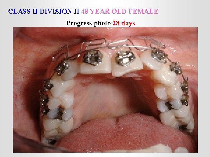 CLASS II DIVISION II 48 YEAR OLD FEMALE Progress photo 28 days 