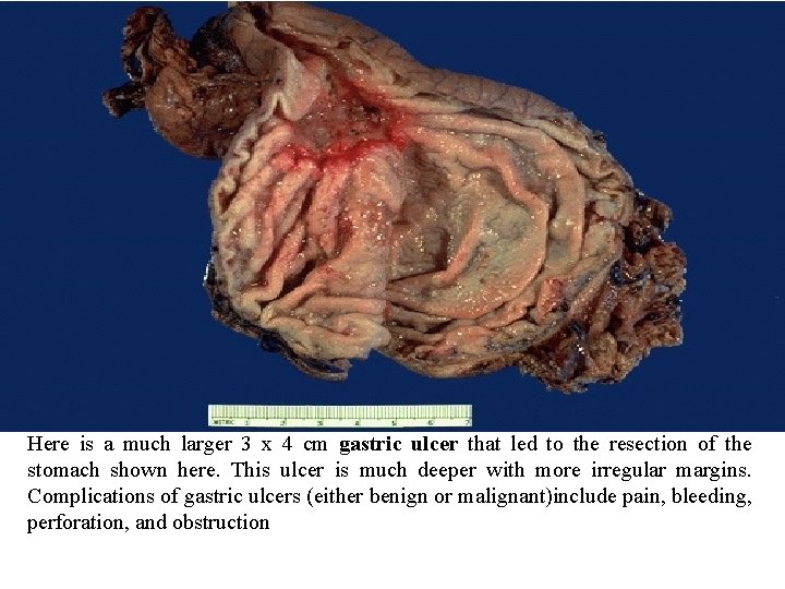Here is a much larger 3 x 4 cm gastric ulcer that led to