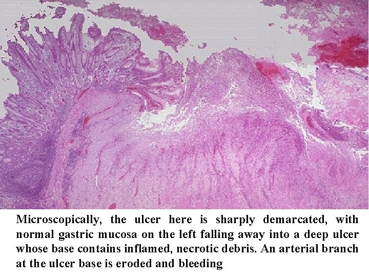 Microscopically, the ulcer here is sharply demarcated, with normal gastric mucosa on the left
