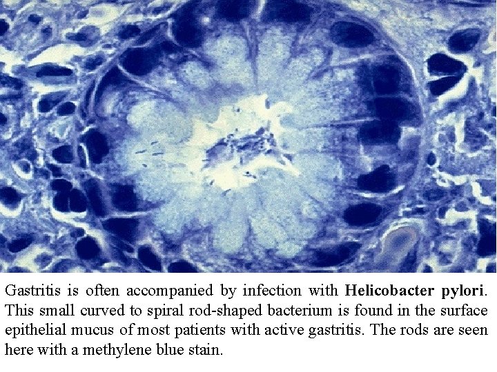 Gastritis is often accompanied by infection with Helicobacter pylori. This small curved to spiral