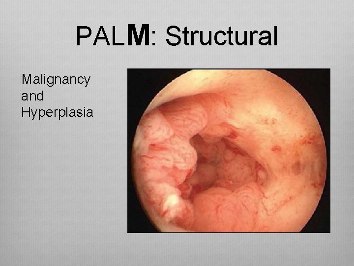 PALM: Structural Malignancy and Hyperplasia 