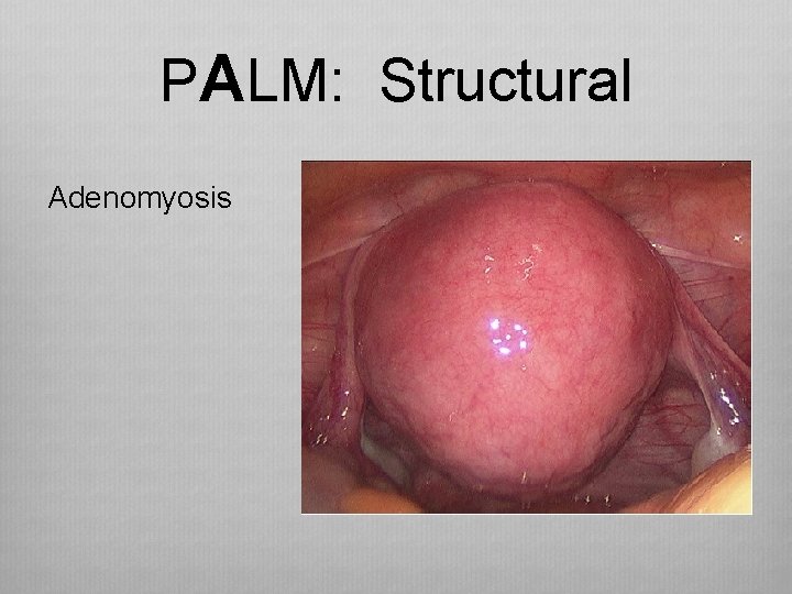 PALM: Structural Adenomyosis 
