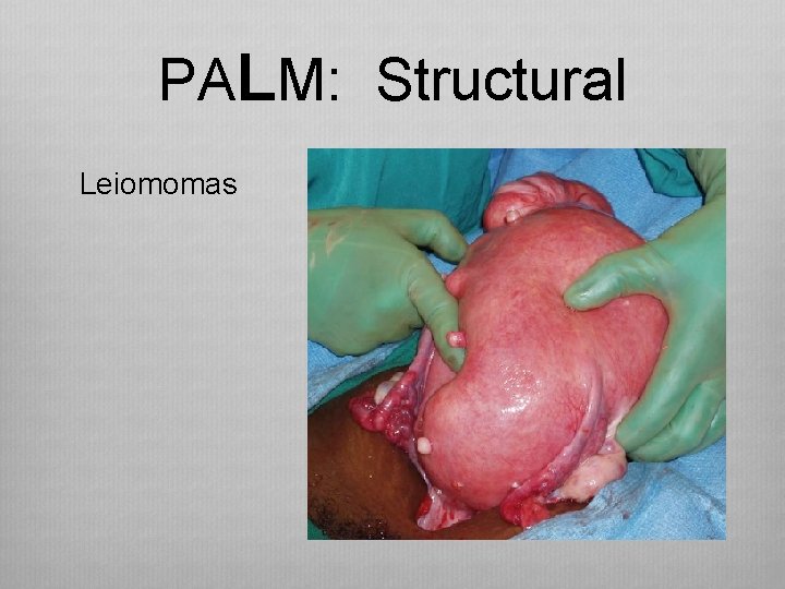PALM: Structural Leiomomas 