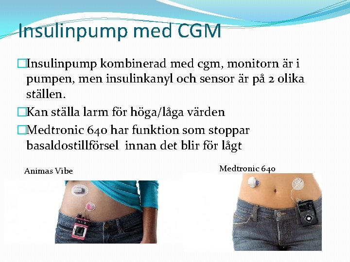 Insulinpump med CGM �Insulinpump kombinerad med cgm, monitorn är i pumpen, men insulinkanyl och