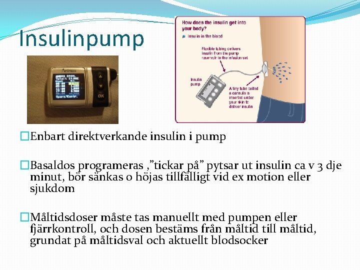 Insulinpump �Enbart direktverkande insulin i pump �Basaldos programeras , ”tickar på” pytsar ut insulin