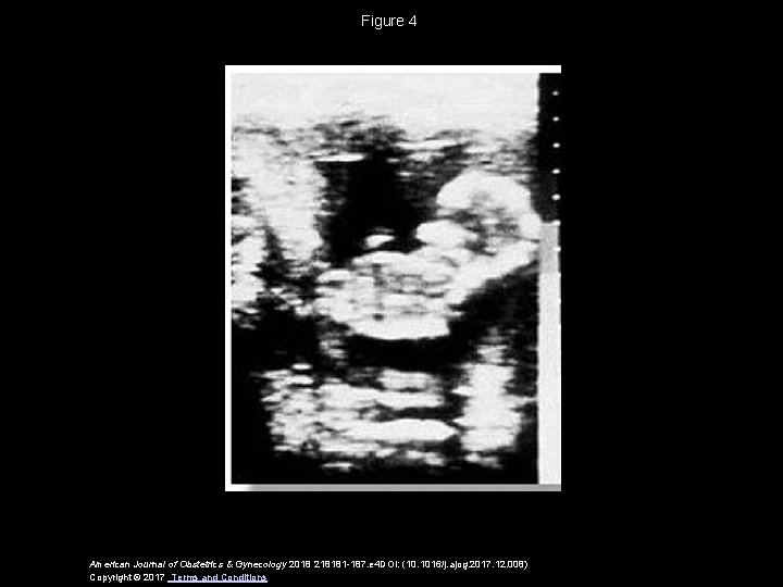 Figure 4 American Journal of Obstetrics & Gynecology 2018 218181 -187. e 4 DOI: