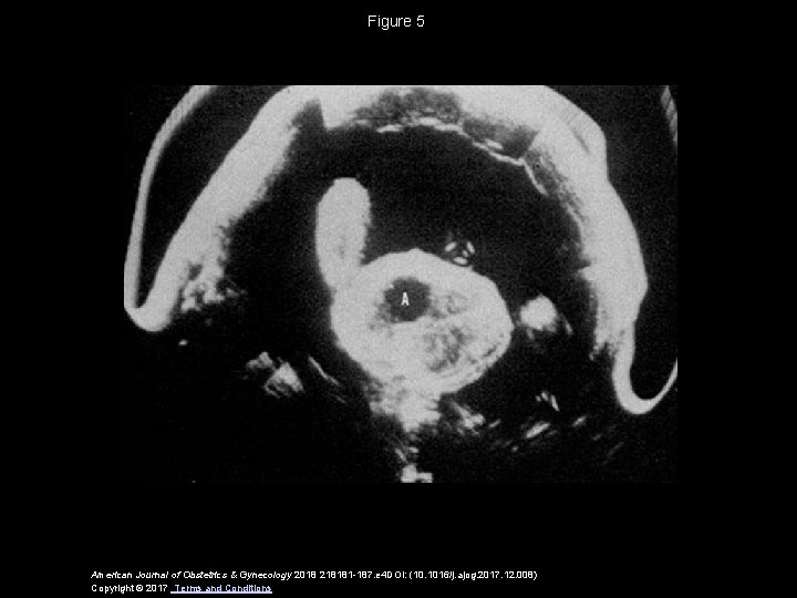 Figure 5 American Journal of Obstetrics & Gynecology 2018 218181 -187. e 4 DOI: