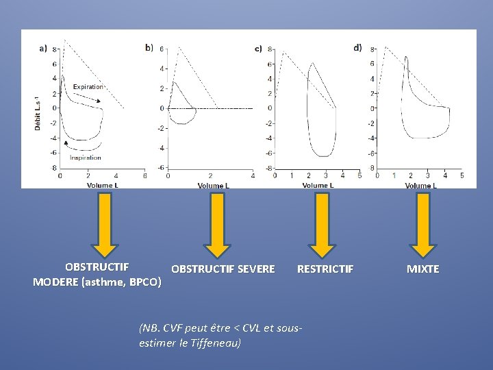 OBSTRUCTIF SEVERE MODERE (asthme, BPCO) RESTRICTIF (NB. CVF peut être < CVL et sousestimer