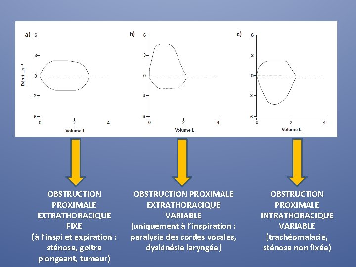 OBSTRUCTION PROXIMALE EXTRATHORACIQUE FIXE (à l’inspi et expiration : sténose, goitre plongeant, tumeur) OBSTRUCTION