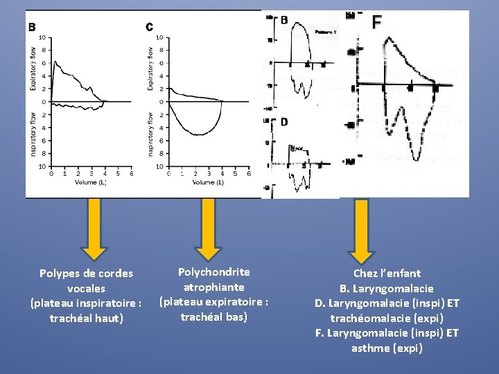 Polypes de cordes vocales (plateau inspiratoire : trachéal haut) Polychondrite atrophiante (plateau expiratoire :