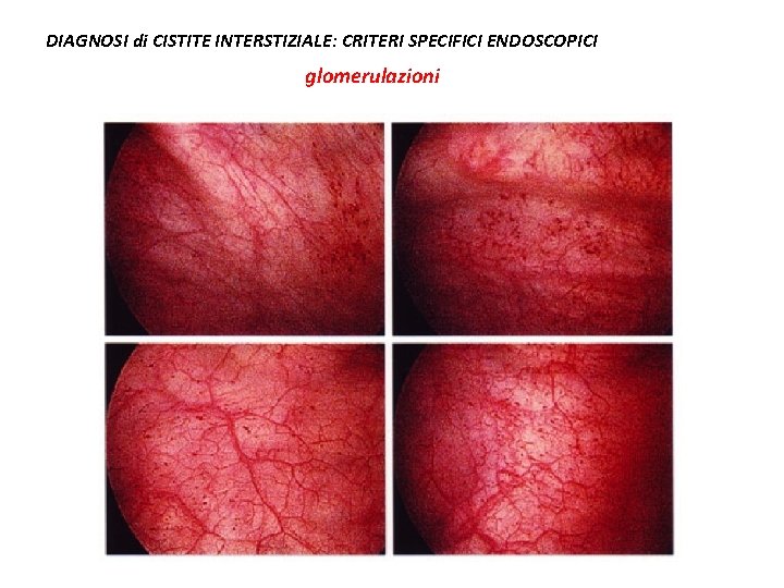 DIAGNOSI di CISTITE INTERSTIZIALE: CRITERI SPECIFICI ENDOSCOPICI glomerulazioni 