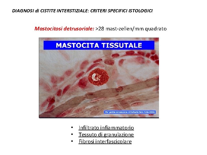 DIAGNOSI di CISTITE INTERSTIZIALE: CRITERI SPECIFICI ISTOLOGICI Mastocitosi detrusoriale: >28 mast-zellen/mm quadrato • Infiltrato