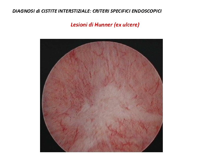 DIAGNOSI di CISTITE INTERSTIZIALE: CRITERI SPECIFICI ENDOSCOPICI Lesioni di Hunner (ex ulcere) 
